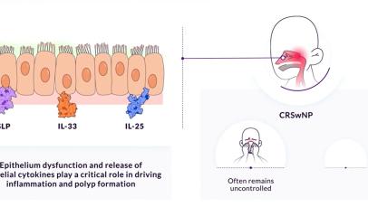Chronic Rhinosinusitis With Nasal Polyps Video