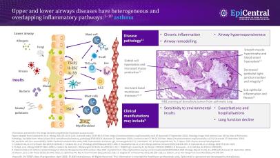 The importance of the epithelium in airway disease teaser