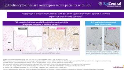 Histological images showing TSLP and IL-33 expression in oesophageal epithelium of patients with EoE.