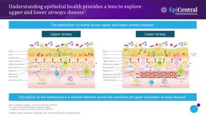 Slide showing how understanding epithelial health provides a lens for exploring upper and lower airway diseases.