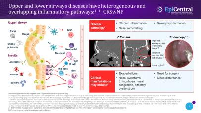 Slide showing the heterogeneous and overlapping inflammatory pathways shared by upper and lower airway diseases, including CRSwNP.