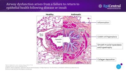 Slide showing airway epithelial changes in patients with asthma compared with a healthy airway epithelium.