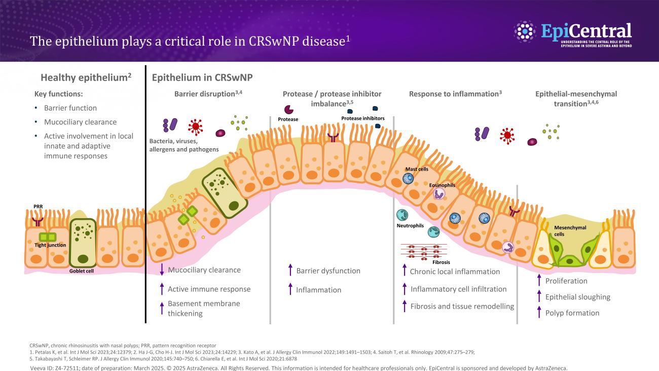 The epithelium plays a critical role in CRSwNP