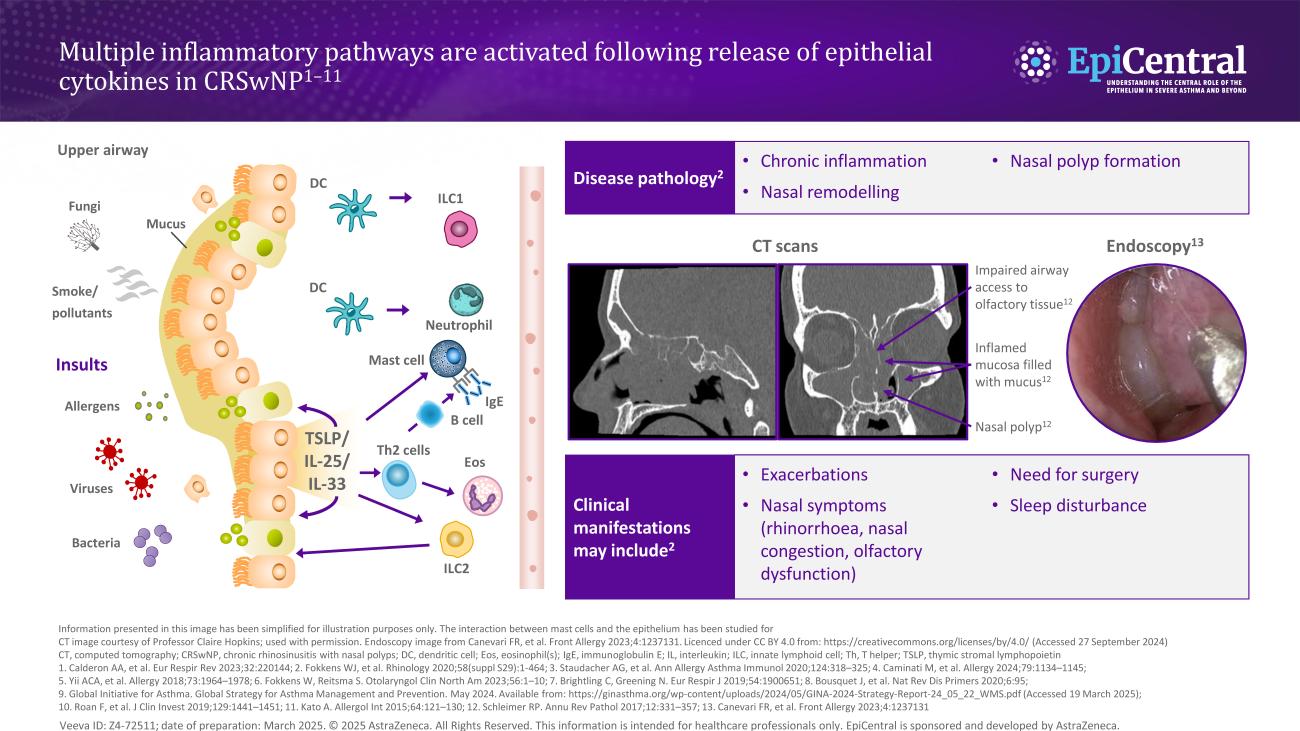 Inflammatory cascade in CRSwNP