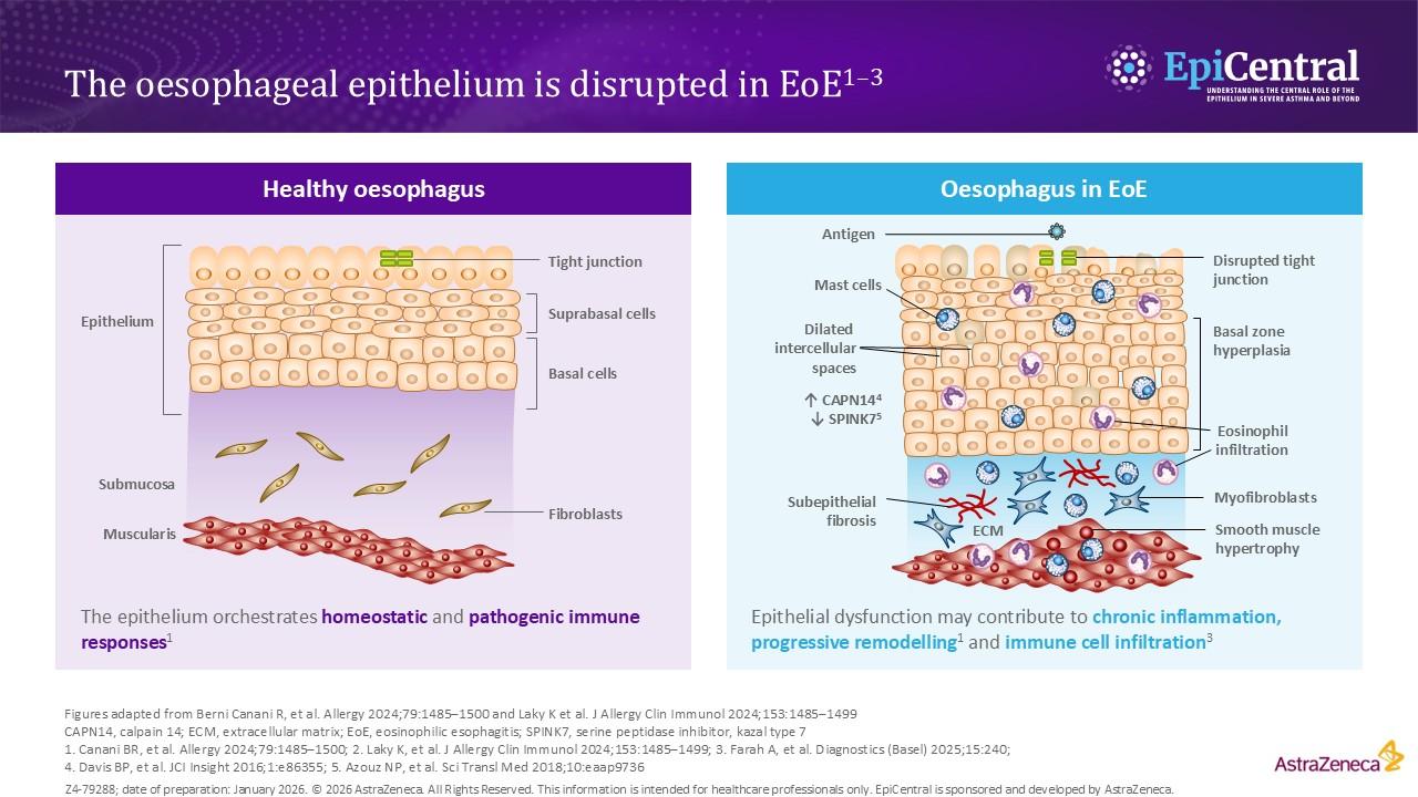 Diagrams showing the differences between healthy and EoE oesophageal epithelium.